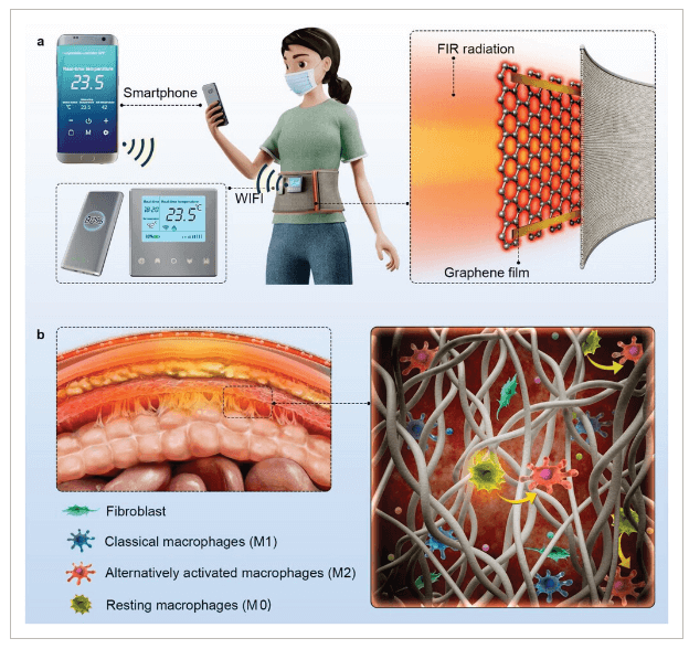 华中科技大学《Adv Sic》：基于石墨烯复合薄膜的可穿戴远红外治疗仪，有效预防术后腹膜粘连